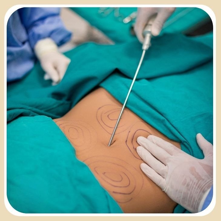 Are there any complications during liposuction?