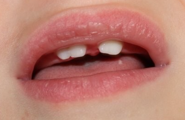 What Parents Should Know About Geminated And Fused Baby Teeth