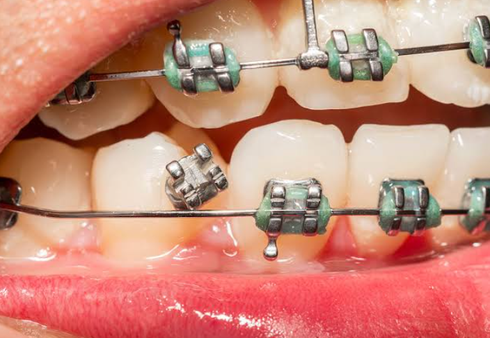 The Role of Orthodontics in Reducing Dental Emergencies