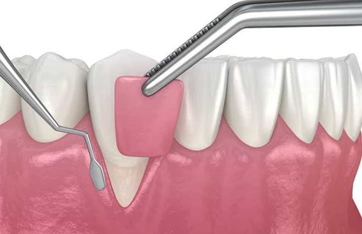 How Cosmetic Dentists Shape Gum Tissue Around A New Implant Crown