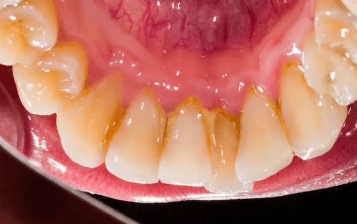 How Family Dentists Evaluate Calcium Buildup Behind The Lower Front Teeth